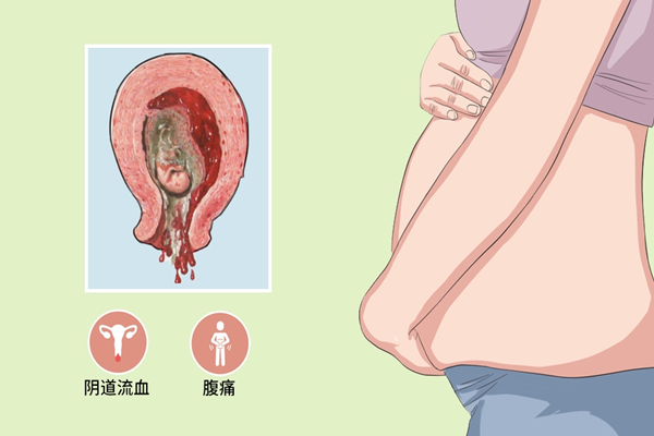 导致流产
