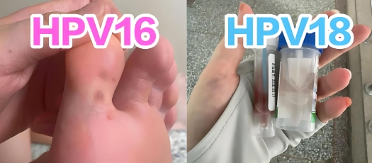 HPV类型