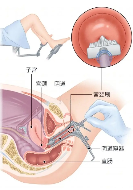 阴道镜