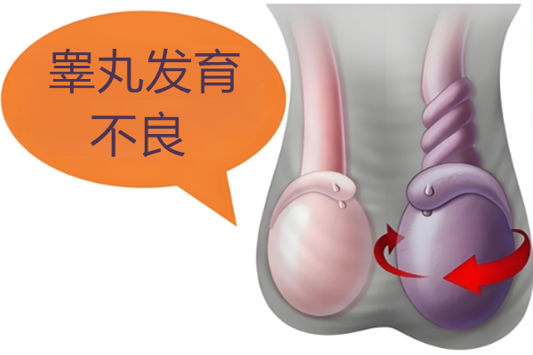 睾丸发育不良