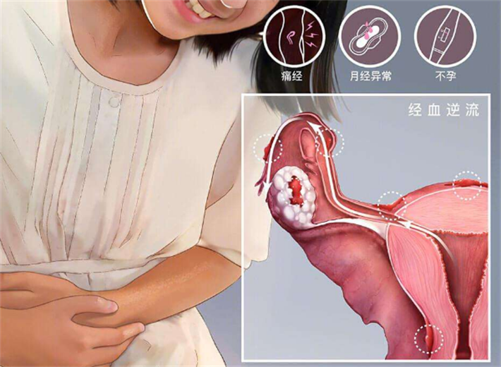 子宫内膜异位症3.png