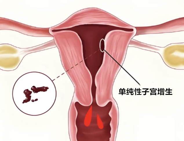 单纯性子宫增生