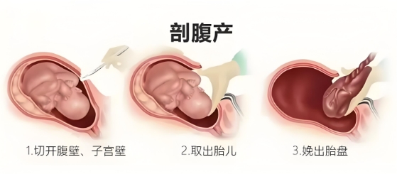 剖腹产