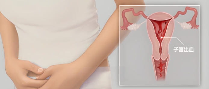 子宫出血