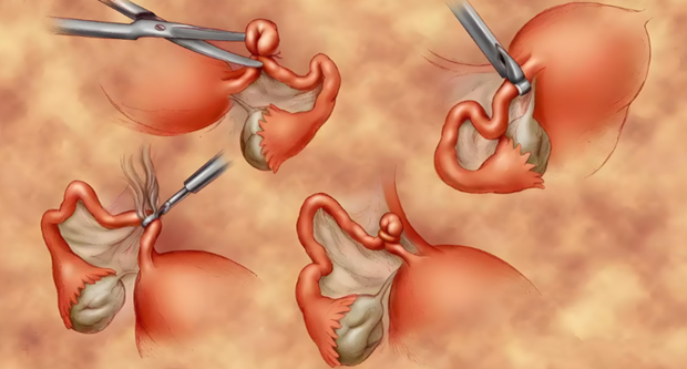 输卵管结扎