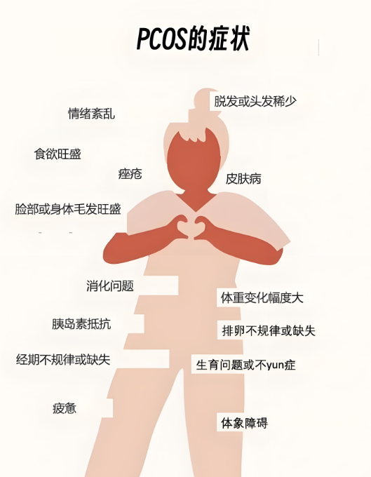 多囊卵巢综合征症状