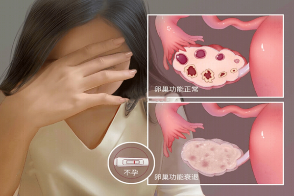 女性卵巢衰退