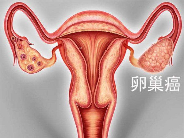 卵巢癌