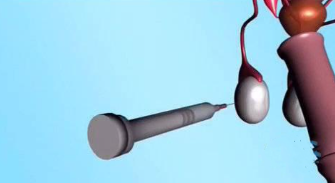 睾丸穿刺 睾丸穿刺