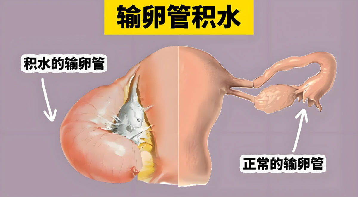输卵管积水不孕