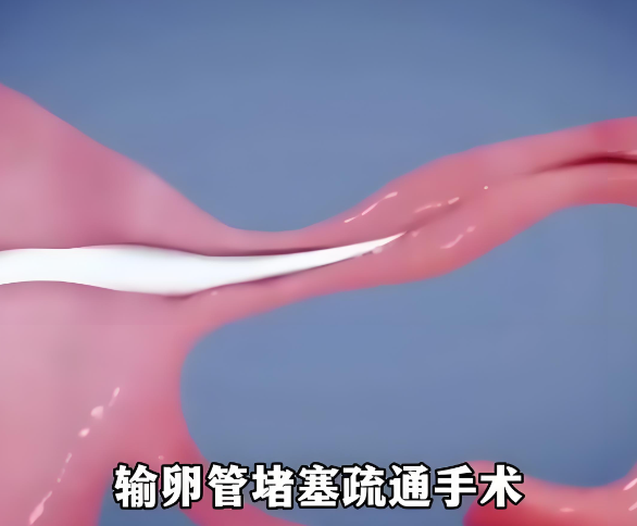 输卵管疏通