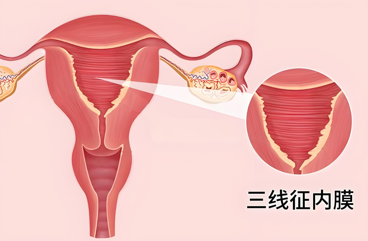 三线征