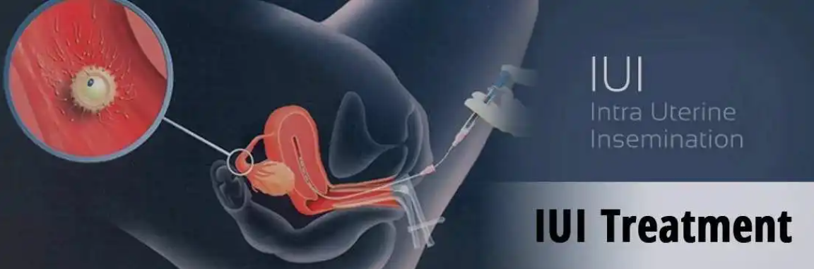 IUI