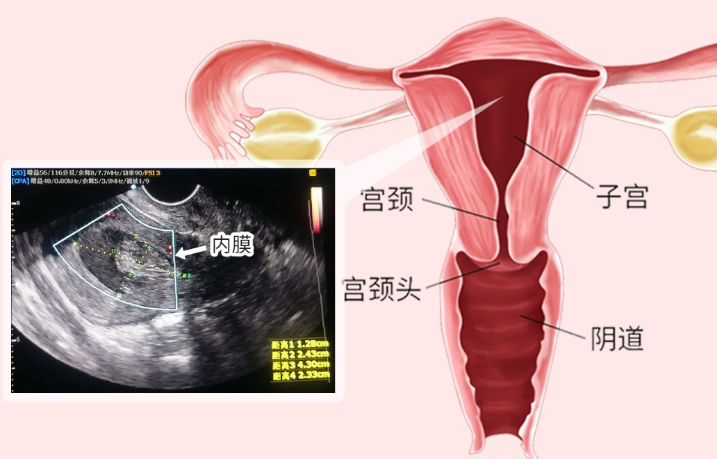 阴道超声