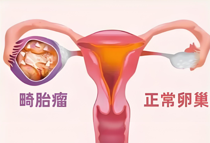 畸胎瘤
