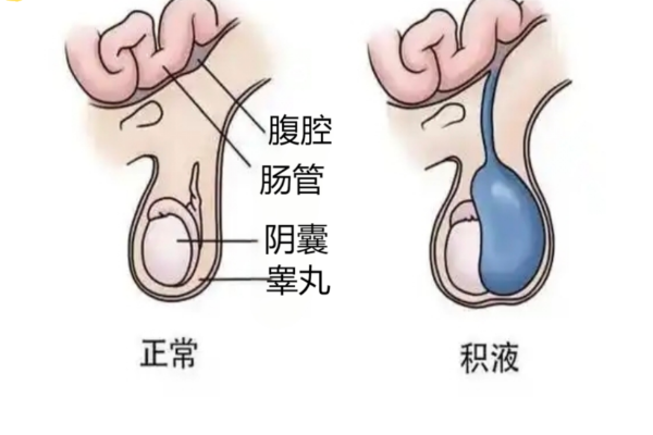 睾丸鞘膜积液