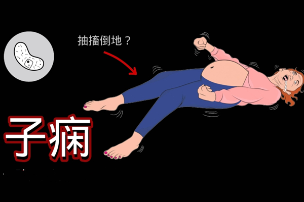 子痫