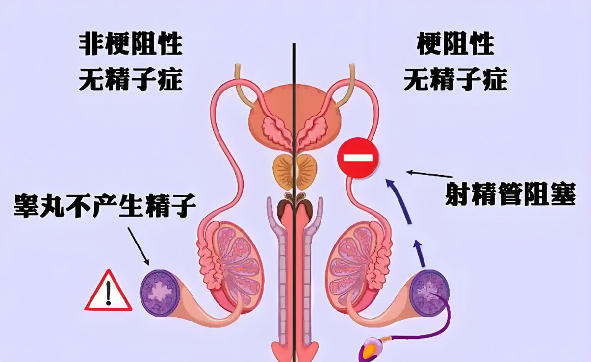 无精症