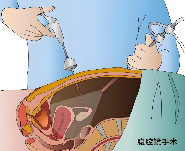 腹腔镜