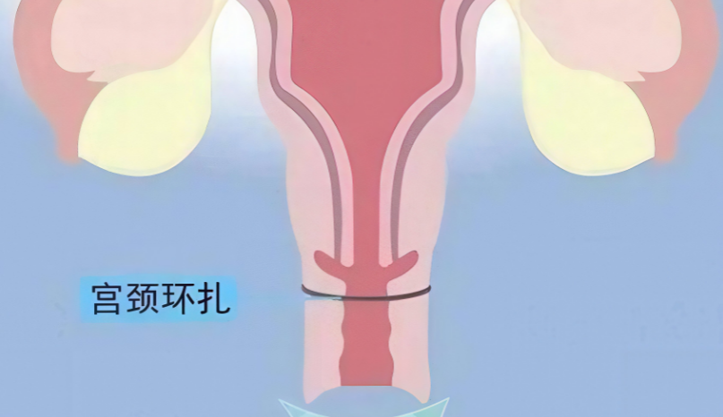 宫颈环扎术